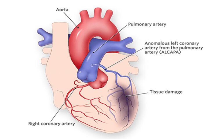 Echocardiography of Coronary Arteries in Congenital Heart Disease ...