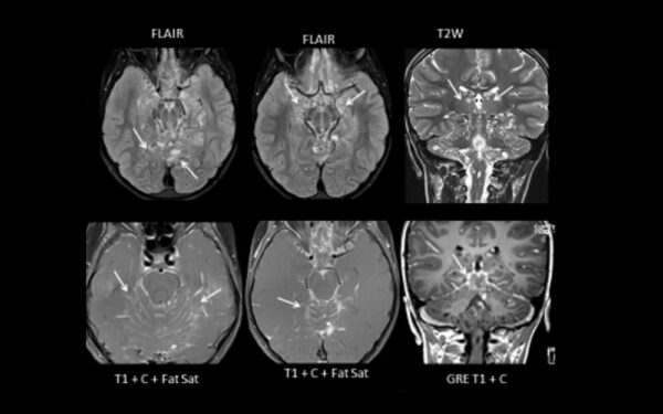 Pediatric Spine Tumors - CHOP OPEN