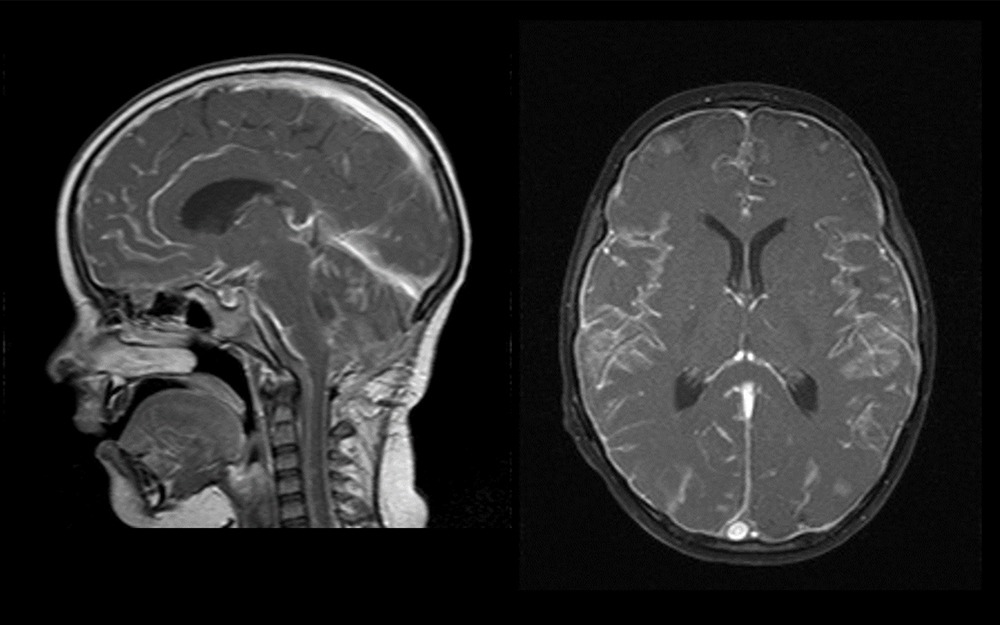 Imaging of Brain Tumor Treatment, Complications and Follow Up 