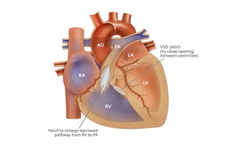 Tetralogy of Fallot and Truncus Arteriosus - CHOP OPEN