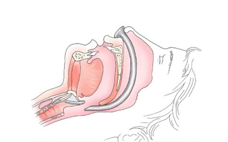 Pediatric Procedural Sedation (Pete Devon 2021) - CHOP OPEN