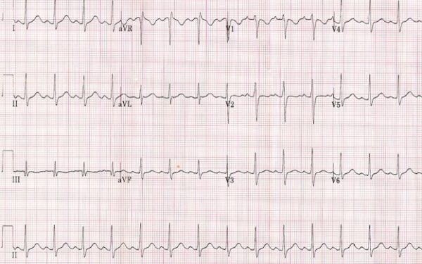 Pediatric Electrocardiograms (ECGs) - CHOP OPEN