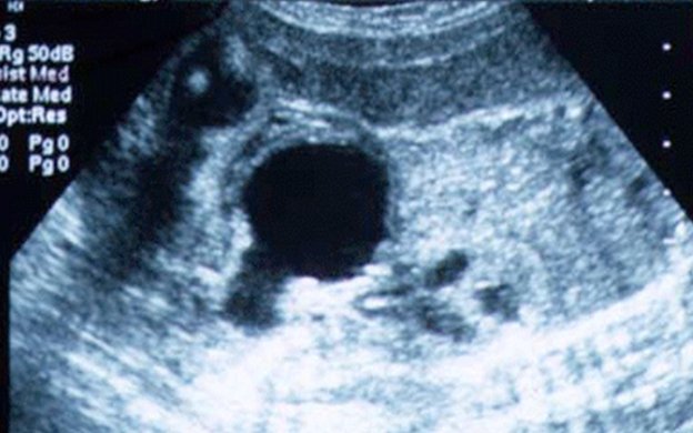 Fetal/Neonatal Renal Failure