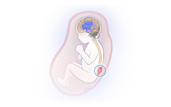 Fetal Fireside: Myelomeningocele (MMC) - CHOP OPEN