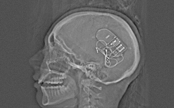 Refractory Epilepsy - CHOP OPEN