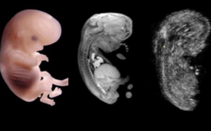 What Fetal MR Adds to Ultrasound in Complex Brain Malformations