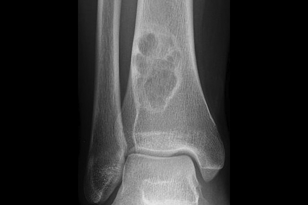 benign bone tumors