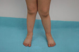 lower limb deformity