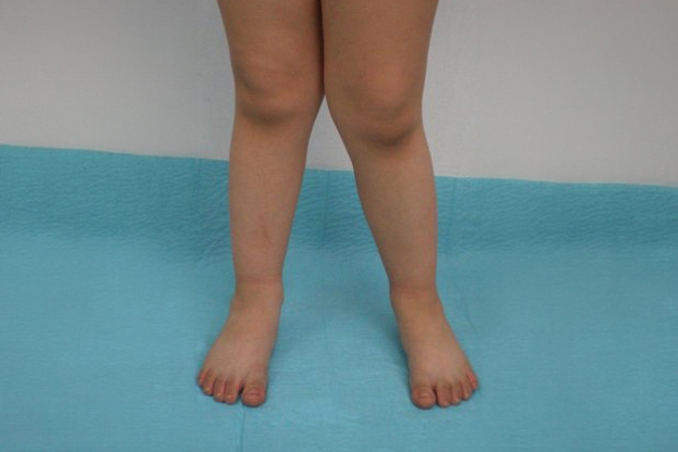 lower limb deformity