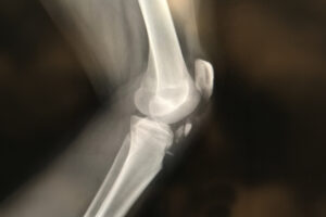 sports injury