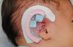 Ear molding for ear deformities