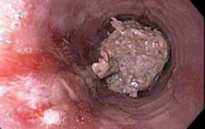 Eosinophilic Esophagitis