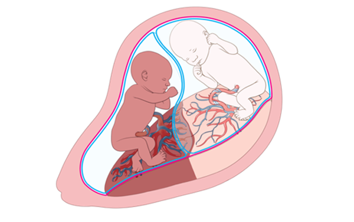 Complex Monochorionic Pathologies: Beyond the obvious culprits