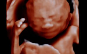 Fetal Fireside: Noonan Syndrome - From Prenatal Findings to Postnatal Management