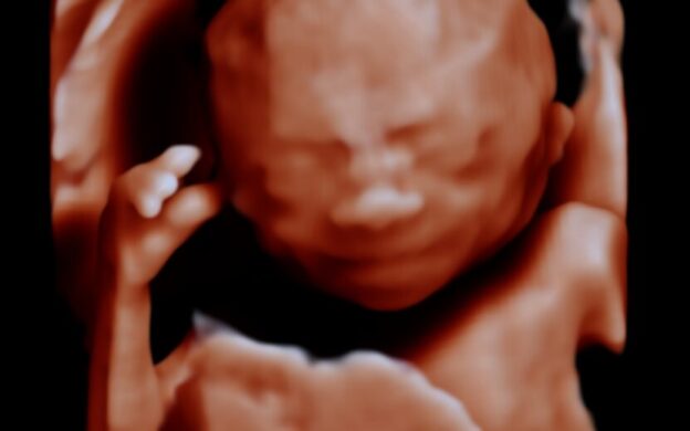 Fetal Fireside: Noonan Syndrome - From Prenatal Findings to Postnatal Management