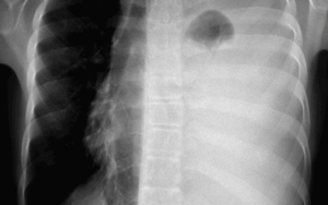 Lymphoblastic Lymphoma in Children