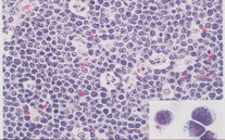 Treatment of Mature B-Cell Lymphomas – CHOP Cancer Center International Seminar Series