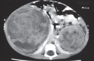 Wilms Tumor