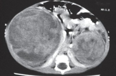 Wilms Tumor