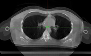 Proton Therapy Planning Considerations – CHOP Cancer Center International Seminar Series