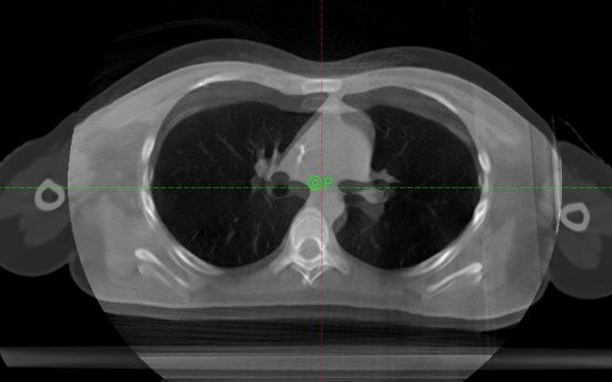 Proton Therapy Planning Considerations – CHOP Cancer Center International Seminar Series